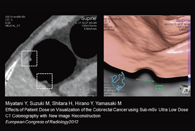 }3@0.71mSv CT ColonographyՏ摜 