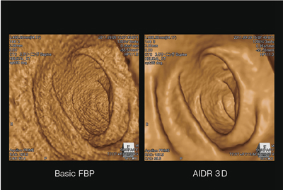 }4@0.15mSv CT ColonographyՏ摜 