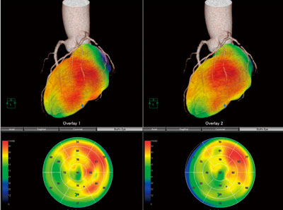図2 フュージョンEX restとstressデータを比較することができる。三次元的なマッピングは,より正確な虚血範囲の形状を表示する。