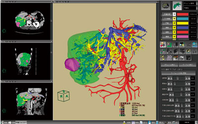 図3 肝臓解析 新しいレンダリング手法により,血管走行を明確に表示できる。