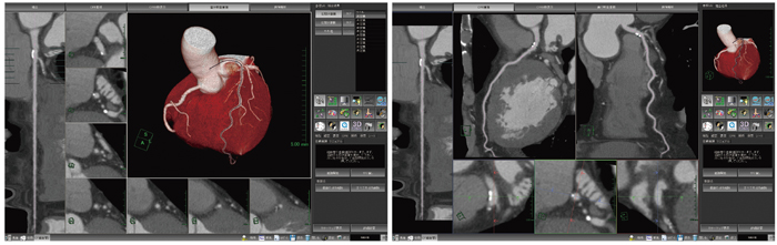 図6 冠動脈解析ソフトウェア シンプルなインターフェイス,改良されたワークフローで冠動脈解析をサポートする。