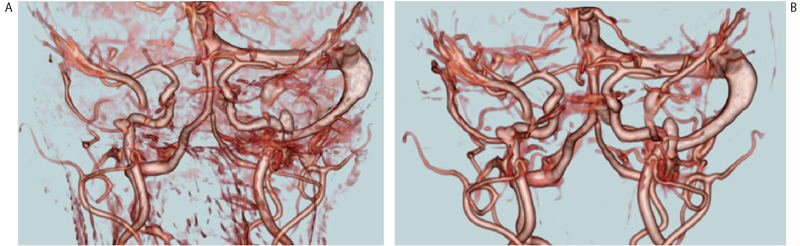 }4@ό`p摜ɂAMI摜iAZEЁCVirtualPlacej A͉ǑOCB͉ǌłCǌ̓mCYĂBAZEЂƃn[o[hw̋J3D SlicerōsCp\tgEFAuVirtualPlacevɈڐAꂽB