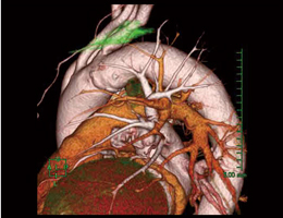 3D-CTɂVATSiox؏pjO virtual imaging