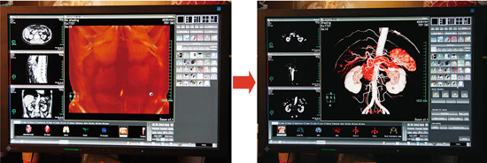新機能“1-Click Segmentation”では,アイコンをワンクリックするだけで臓器が自動抽出される。