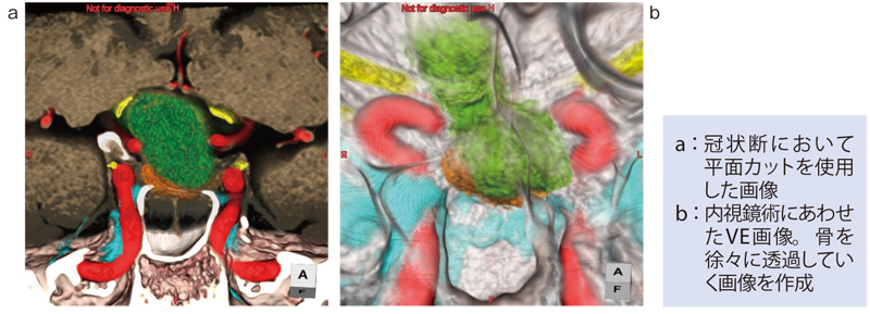 症例1　マルチデータフュージョンを生かした下垂体腫瘍における術前シミュレーション画像 （赤：動脈、青：静脈、緑：腫瘍、黄：視神経と動眼神経、オレンジ：正常下垂体）。CT（plain＆3D-CTA）とMRI（FIESTA＆SPGR）の合計4つのデータをフュージョンすることで、腫瘍により圧迫された視神経や正常下垂体を立体的に把握できる。