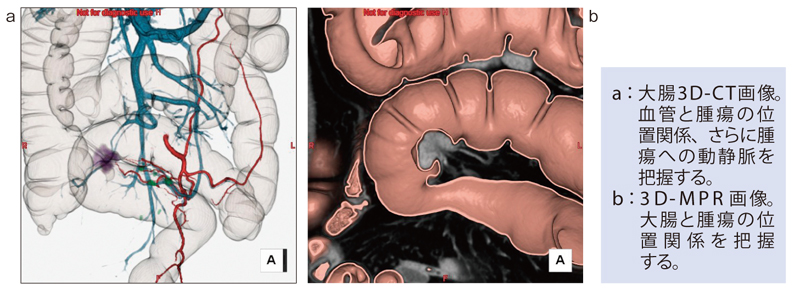 症例2　S状結腸がん術前の大腸3D-CT画像（赤：動脈、青：静脈、紫：腫瘍、緑：リンパ節、半透明：大腸）である。血管（3D-CTA）と大腸（Air3D-CT）をフュージョンした。腹腔鏡補助下S状結腸切除術＋D3郭清の術前シミュレーションに役立った。