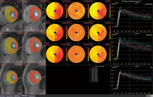 MRパフュージョン解析結果画面（ziostation2） 左：心筋画像上に血流量をカラー化したものを重ね合わせて表示 中央：安静・負荷時の心筋血流量と冠血流予備能をbull’s eye map表示 右：心筋血流信号の経時変化をグラフ化して表示