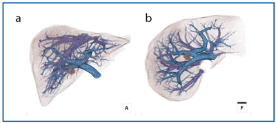 図6　 フュージョン画像（門脈・肝静脈・肝実質・腫瘍） a：正面から見た画像、b：足側から見た画像 術前検査では門脈・肝静脈の走行が最も重要な情報となる。実際は360℃回転した画像をそれぞれ作成する