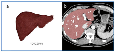 図7　肝臓ボリューム計測画像（a）とマスク画像（b）