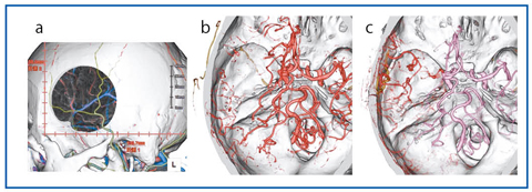 図5　外頸動脈−中大脳動脈バイパス術