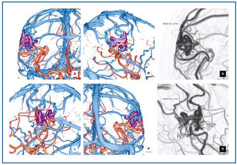 図7　動静脈奇形の処理画像