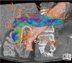 図1　3D 膵Perfusion CT画像