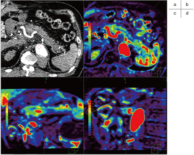 図2 3D 膵Perfusion CT画像