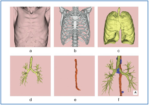 図2　Multivolumeの例 a：体表、b：骨、c：肺、d：気管気管支、e：食道、f：腫大リンパ節 マルチデータフュージョンでは、ボリュームごとの加算表示・非表示の選択ができ、 ボリュームごとに異なったカラーも適応可能である。