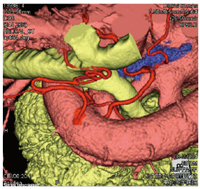 図4　各解剖学的構造の相互関係が気管支動脈を含めて良好に観察できる。 赤：大動脈、濃赤：気管支動脈、 黄：気管支・肺、青：リンパ節