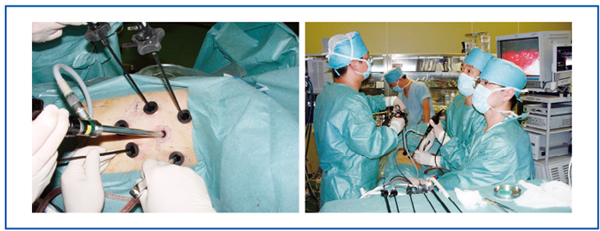 図6　胸腔鏡下食道手術 左側臥位、6ポートの完全鏡視下で胸部操作を行う。
