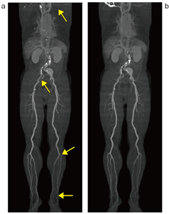 図3　体幹部骨除去処理における高速処理（a）と高精度処理（b）の3D- CTA画像