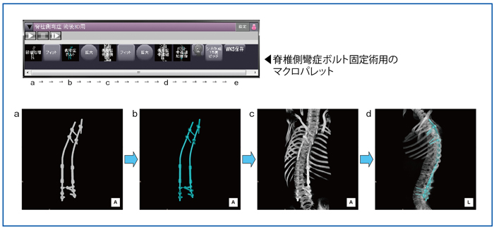 図4　脊椎側彎症ボルト固定術用のマクロパレットと自動前処理のプロトコル