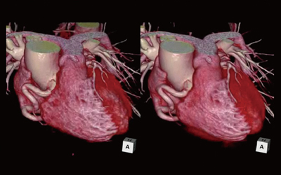 図1　PhyZiodynamicsによる心臓の再構成画像。10フェーズ（左）と50フェーズ（右）