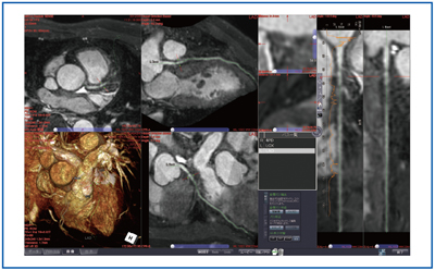 図2　冠動脈MRA（Whole Heart Coronary MRA）の冠動脈詳細解析ソフト