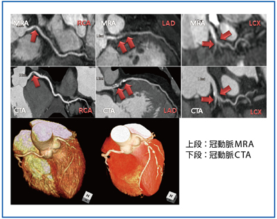図4　心臓ドックで発見された無症候性心筋虚血（SMI）