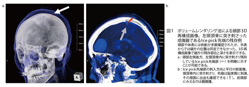 図1　ボリュームレンダリング法による頭部3D再構成画像。左頭頂骨に突き刺さった成傷器であるIce pick先端の残存例