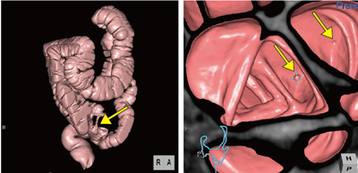 ■症例4　大腸内視鏡にて全周性璧肥厚を認め、カメラ通過困難なためCTCを行ったS状結腸がん症例
