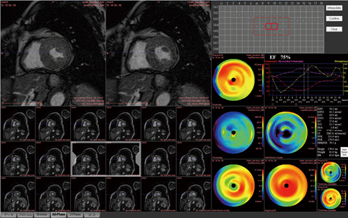 }1@LV analysis Sؗ֊sg[X@\ɂCȕւɐS@\]\ƂȂB܂Ctime-volume curveCventricular volumeCpeak filling rateiPFRjCtime-to peak filling ratevZ\łB̎wẂCg@\]ɗLpłB