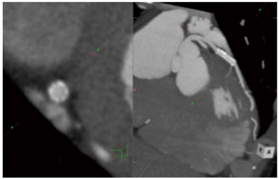 }2@}NSlab MIPr[ uCAEg؂ւvuMPR\vuMIPݒvuMIP\v܂ŁCȀNbNŐiSlab MIPp̊ώ@ʂƂȂB̏ԂŒʂώ@ĂBZʂώ@ꍇ́uMPRQƐv{^NbN΁CʂƉ摜NȂZʂώ@邱ƂłB