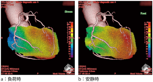 }5@CT-SPECT Fusion Imaging 