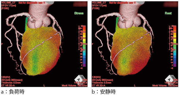 }6@CT-SPECT Fusion Imaging LAD̈̍[ǁ{ωiperi-infarct ischemiajF߂B 