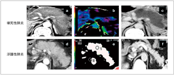 }2@dǋ}XւPerfusion CTp̗Lp Ǒi3ȓj̑eCTł́CXeĂ悤ɌiajBǑi3ȓjPerfusion CTɂXJ[}bvł́C[̃XP[o[ɏ]ČĂibjBȃeCTƈقȂC̕ቺE܂\ꂸCłɉ󎀂Ă\ꂽBǌiDay14j̑eCTł́CPerfusion CTŎꂽቺʂC󎀁EXEƂ悭킩icjBǑi3ȓj̑eCTł́C󎀕ʂ͂ȂidjCǑi3ȓjPerfusion CTł͑CWhite OutĂiejB3Tȍ~̑eCTł́C󎀂𗈂PĂifjB