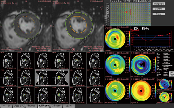 }5@ Ǘ2FZIOSTATIONɂ ǉ^ XN[jOǗɂCKVlMR摜pčǉ^͂{sĂBEFioĵقCEDFigeρjCESVikeρjCSVi1񔏏oʁjCCOiSoʁjCCIiSWj\ClƂ̍𖾊mɂĂB܂CSʑƍSoeς̊֌WԗeϋȐPFRiPeak Filing RatejCPERiPeak Ejection RatejZoāCS̊g\k\]ĂB 