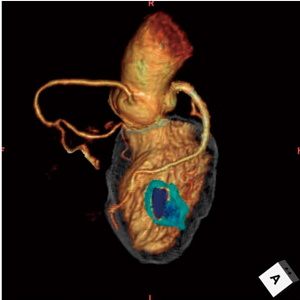 }2@Whole Heart MR{LGE