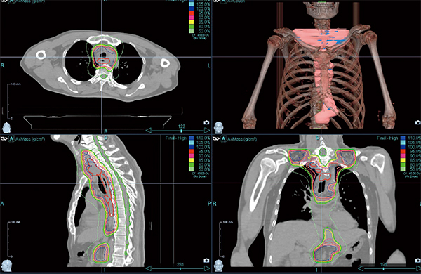 図1　両側頸部および腹部リンパ節転移のある進行食道がん症例 両側頸部リンパ節転移があると，従来の放射線治療（3D-CRT）では多くの症例で根治的放射線治療は困難となるが，IMRTにより根治的治療が可能となる。Radixactを利用することにより，腹部リンパ節転移に対してもつなぎ目のない放射線治療が可能となった。