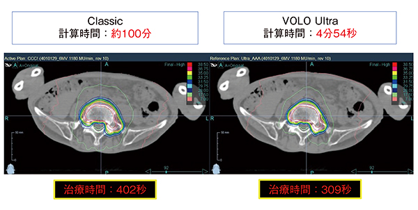 図4　オリゴ転移（腰椎）症例に対する定位放射線治療 VOLO Ultraを使うことで，従来の最適化プログラム（Classic）での計算時間（約100分）の約1/20の4分54秒で完了し，放射線治療時間も309秒と約3/4に短縮できた。