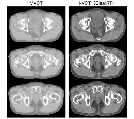 図5　従来のMVCTとkVCT（ClearRT） との画質の違い 軟部組織の分解能が向上し，診断用CTにより近い画質となった。