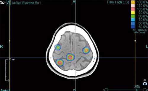 図2　症例：多発転移性脳腫瘍 近在している腫瘍は同時に照射を行う。