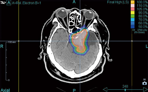 図3　症例：巨大髄膜腫 手術との併用を念頭に経過を観察し，状態に応じて照射を選択する。