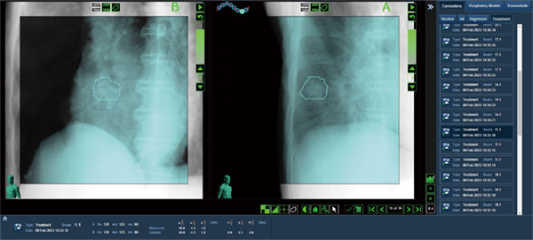 図2　肺野腫瘤の定位照射 直接肺腫瘤を認識して追尾照射を行っている。