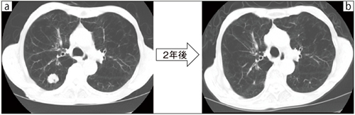 図2　代表的症例の治療経過 a：右肺下葉に20mm大の結節を認める。 b：結節は縮小し，肺臓炎は認めない。
