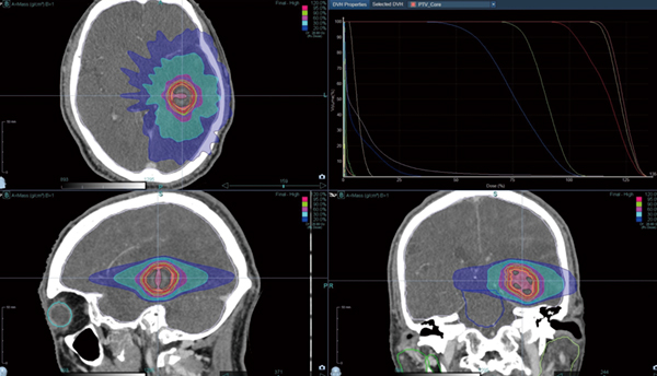 図1　原発性肺がん脳転移 SRT 28.8Gy/4fr PTV D95処方
