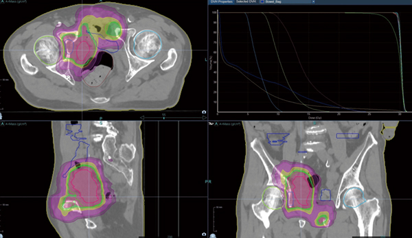 図2　多発性転移（膀胱がん術後骨盤内播種，恥骨・右臼蓋骨転移）に対する緩和照射 Beam on time 247秒