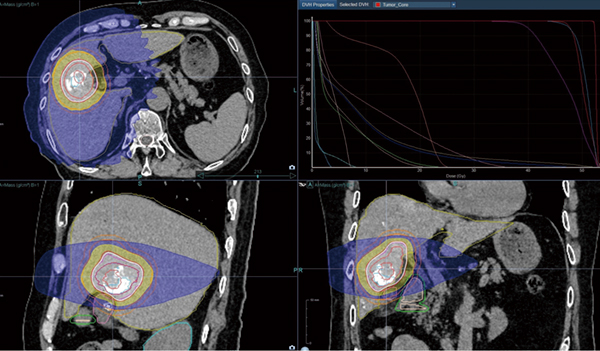 図3　TACE後リピオドールを利用したSynchrony（マーカーレス）のSRT 治療計画は単純および造影CTによるCT/CT fusionで実施した。