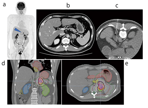 図5　副腎腫瘍に対する動体追尾照射例