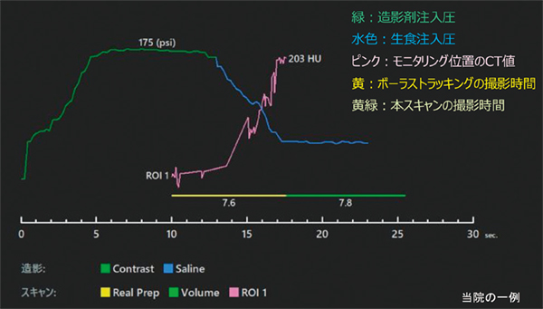 図7 冠動脈CT検査における造影剤注入結果