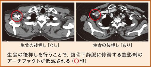 図1 生食の後押し効果（鎖骨下静脈のアーチファクト）（自験例）