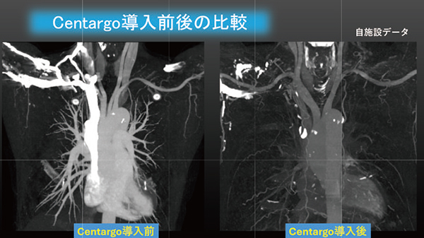 図2  生食後押し効果の比較(鎖骨下動脈)