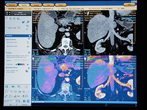 参考展示された二層検出器技術によるSpectralイメージング