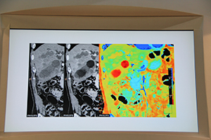 スペクトラルイメージング：実効原子番号（Z effective）画像（右）